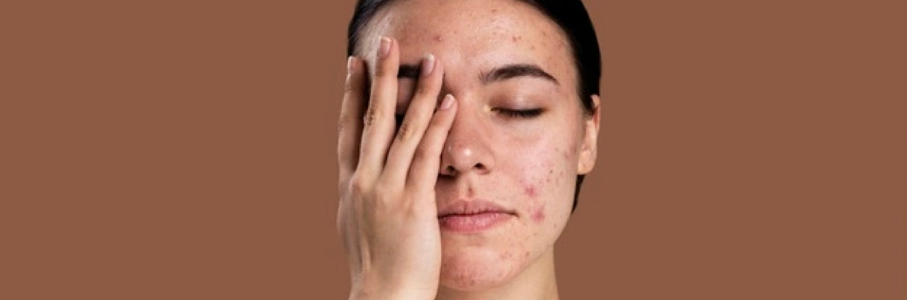 This is an image for a blog on Daily actions that cause acne breakouts on www.sublimelife.in