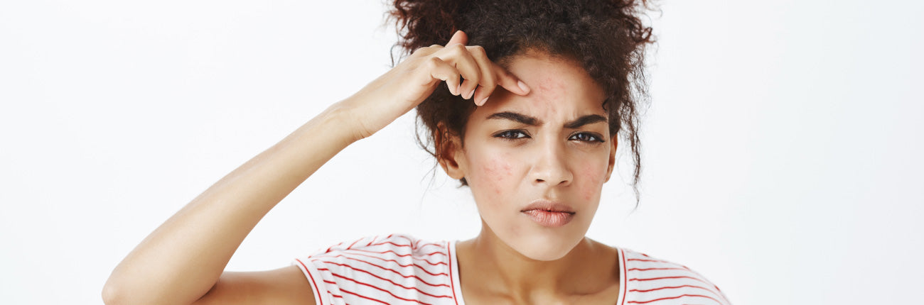 This is an image for Purging V/s Acne Blog on www.sublimelife.in