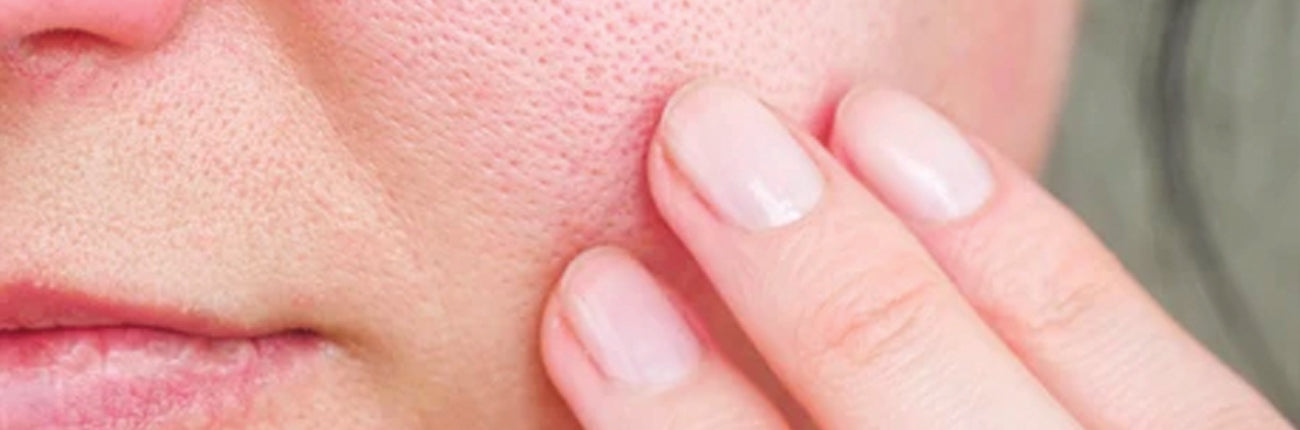 A blog on Enlarged Pores and how to deal with them on www.sublimelife.in