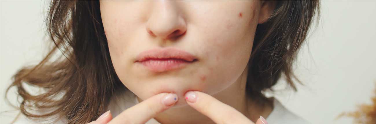 This is an image for a blog on Popped a Pimple? The guidebook on how to deal with it on www.sublimelife.in