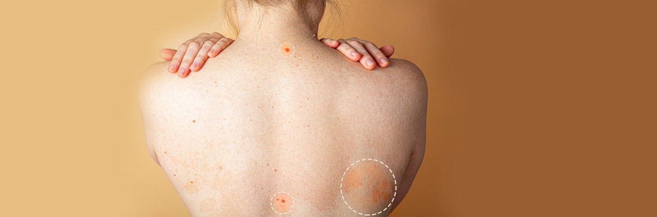 This is an image of body acne