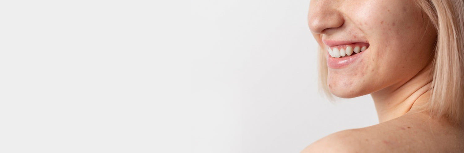 This is an header image of a blog on Congested Skin on www.sublimelife.in