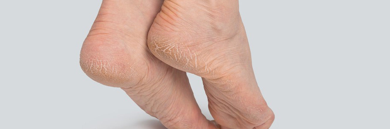 This is an image of an article on Cracked heels on www.sublimelife.in.