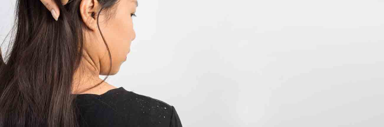 This an image of dandruff