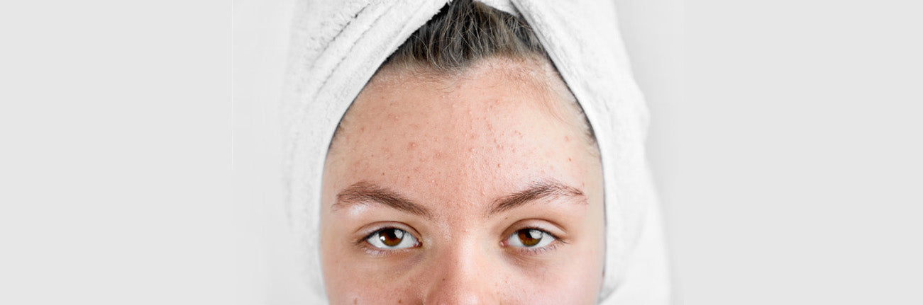 This is an image of Hormonal Acne