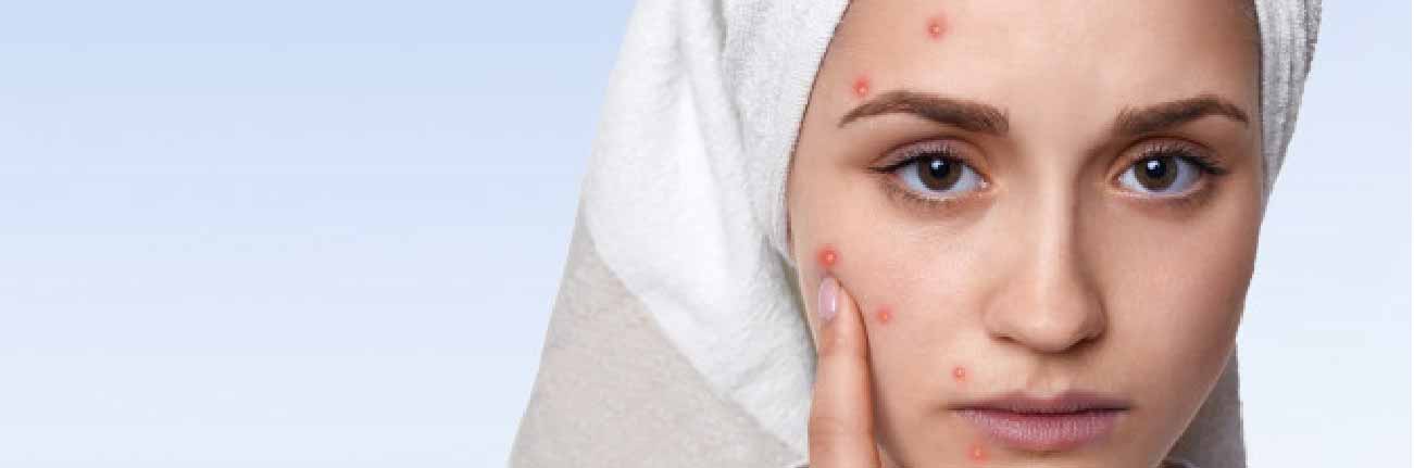 This is an image of a clean beauty routine for acne prone skin on sublimelife.in