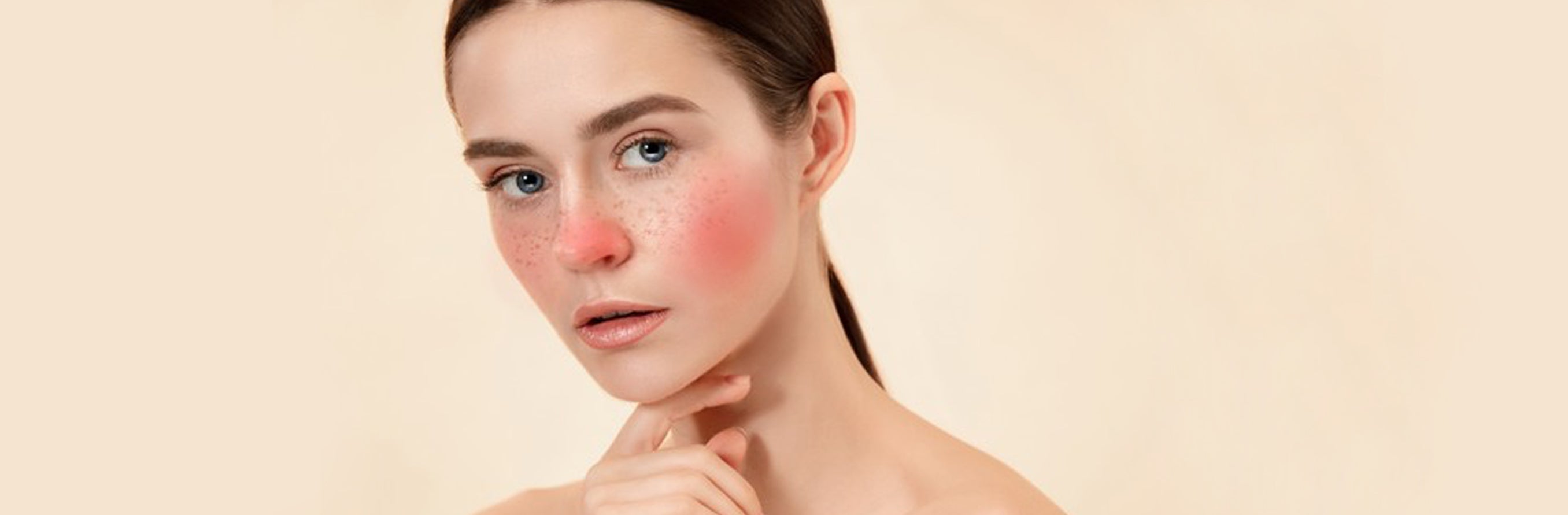An image for a blog on Rosacea, Causes, Types and Treatment on www.sublimelife.in