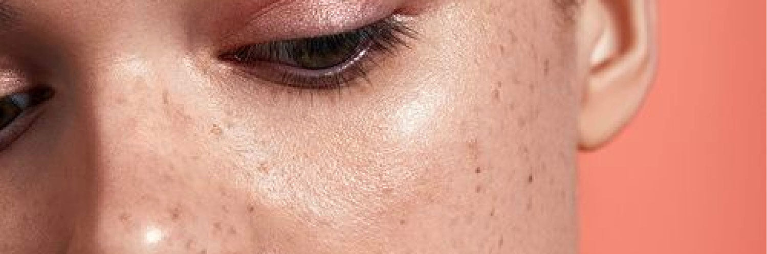 This is an image showing acne scars and use of 13 effective ingredients to lighten acne scars