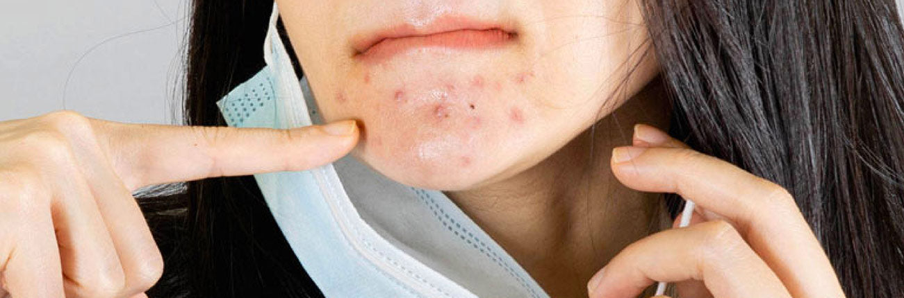 This is an image showing face masks acne or Maskne