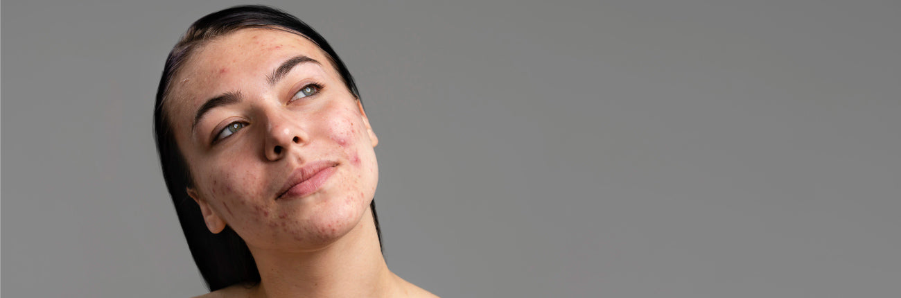 A blog on Busted Acne Myths: For glowing skin on www.sublimelife.in
