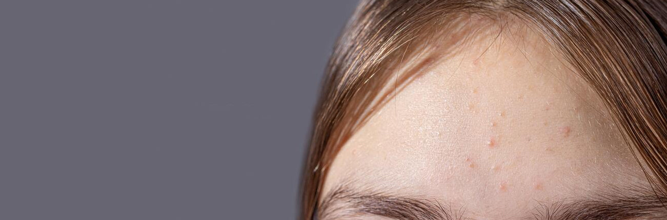 This is a blog on Forehead Pimples and how to treat them on www.sublimelife.in 