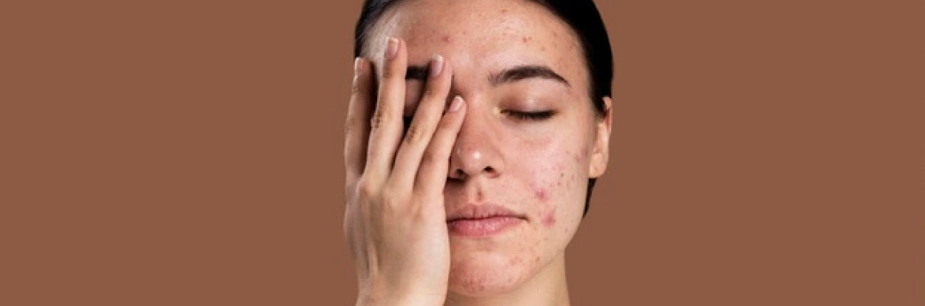 This is an image for a blog on Daily actions that cause acne breakouts on www.sublimelife.in 