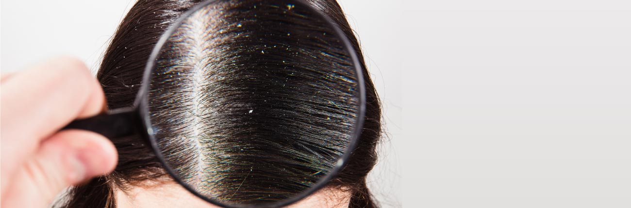 A blog on Dandruff or Psoraisis Know the Difference on www.sublimelife.in