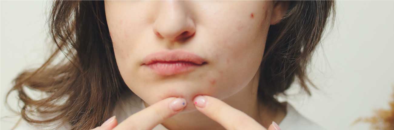 This is an image for a blog on Popped a Pimple? The guidebook on how to deal with it on www.sublimelife.in 