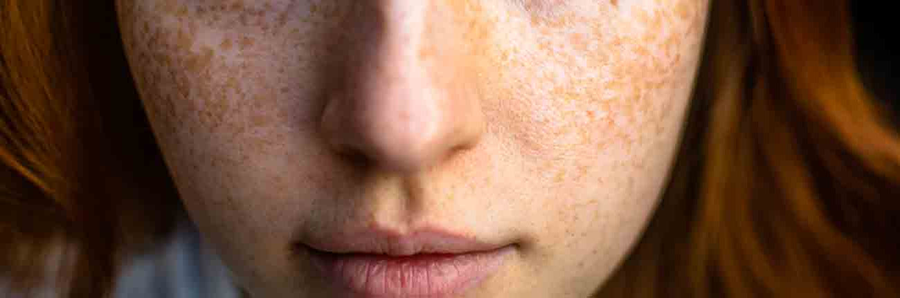 How to get rid of hyperpigmentation the dermatologist-approved way?