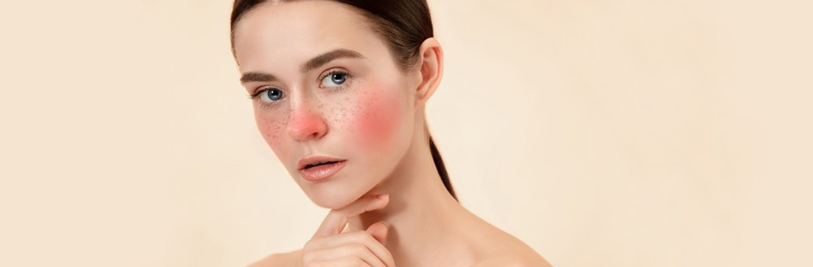 An image for a blog on Rosacea, Causes, Types and Treatment on www.sublimelife.in 
