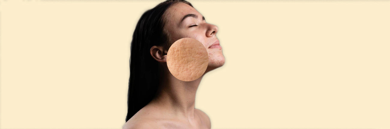 This is an image for a blog on 5 tips to prevent pitted acne scars on www.sublimelife.in 